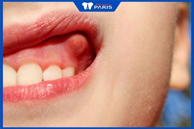 Các dấu hiệu viêm chân răng phổ biến