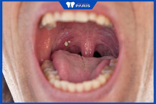 Hạt trắng trong họng: Nguyên nhân và cách khắc phục hiệu quả