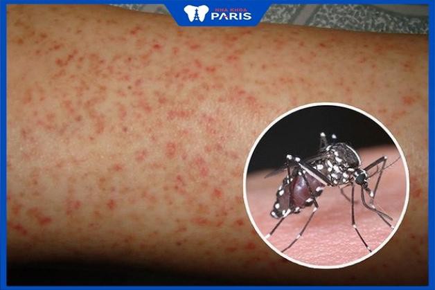 Sốt xuất huyết do virus Dengue
