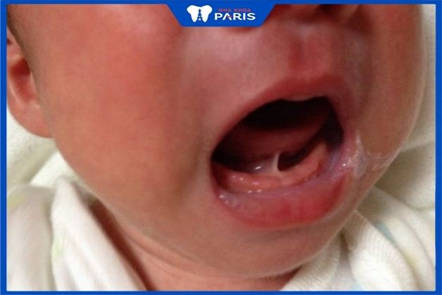 Dính phanh lưỡi ảnh hưởng tới trẻ thế nào? Cách điều trị dứt điểm