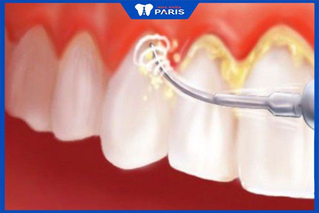 Lấy cao răng phòng ngừa viêm lợi chảy máu chân răng