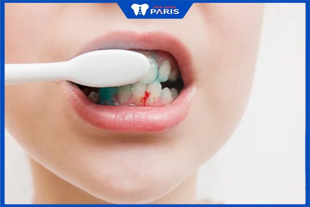 Nguyên nhân gây ra viêm lợi chảy máu chân răng