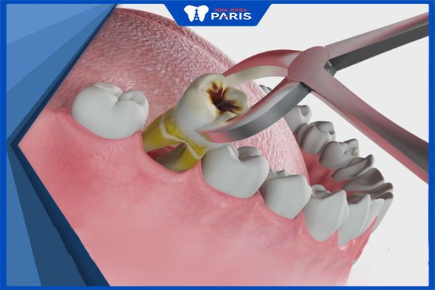 Nhổ răng hàm có nguy hiểm không, biến chứng có thể xảy ra