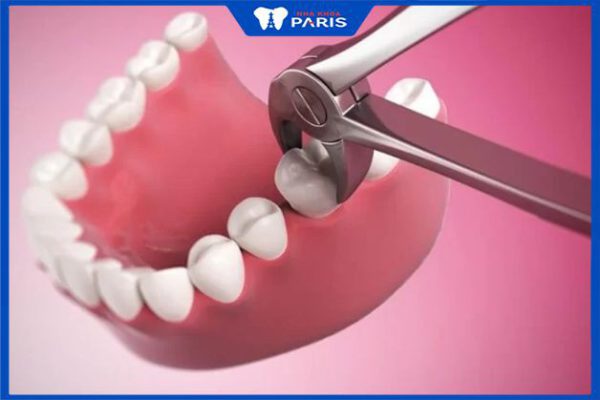 Nhổ răng hàm có nguy hiểm không? Các biến chứng có thể xảy ra