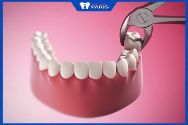 Nhổ răng khôn sưng bao lâu? – 5 tips giảm sưng nhanh chóng