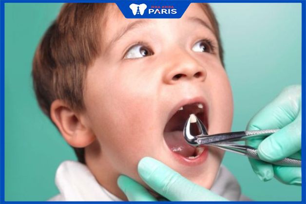 Nhổ răng sữa sớm thì răng vĩnh viễn có mọc sớm không?