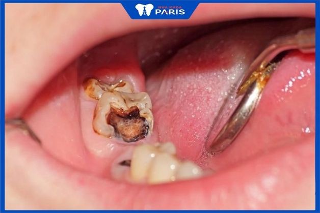Nhức răng hàm dưới do sâu răng
