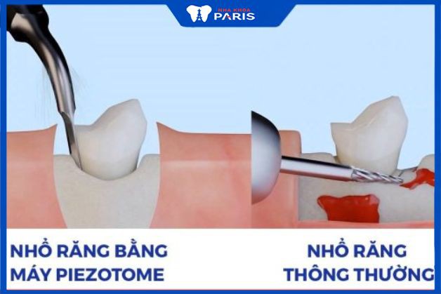 So sánh phương pháp nhổ răng hàm truyền thống và Piezotome