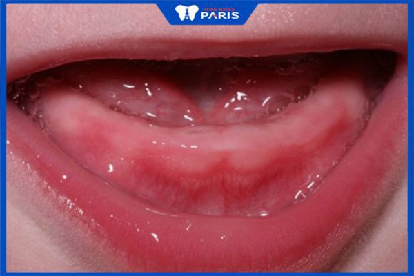 Mách bạn 4 cách hiệu quả giảm đau sưng lợi mọc răng ở trẻ