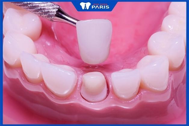 Tẩy trắng răng không phù hợp với răng sứ tẩy trắng răng có an toàn không
