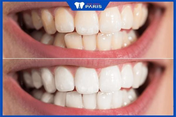 Tẩy trắng răng có đau không – Giải đáp từ bác sĩ Nha khoa Paris