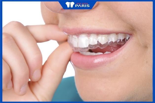 Tẩy trắng răng có đau không nếu ngậm máng tẩy?