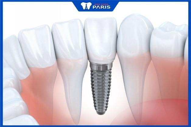 Phương pháp cấy ghép răng Implant