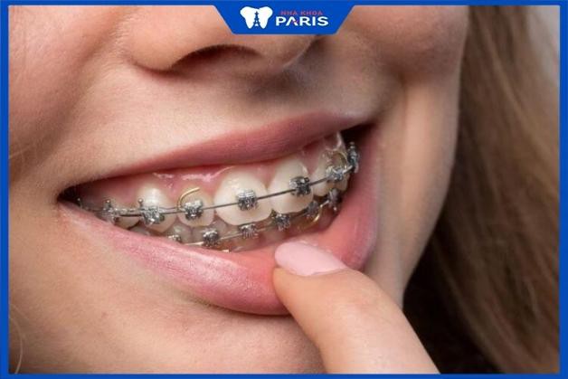 Niềng răng nên được thực hiện trước khi trồng Implant