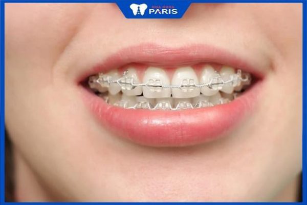 Giải đáp: Trồng răng Implant có niềng được không? Tại sao?