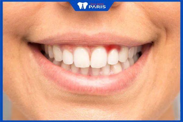 Viêm nướu răng ở người lớn: Nguyên nhân và cách chữa trị