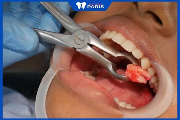 Khách hàng nhổ răng khôn tại Nha Khoa Paris