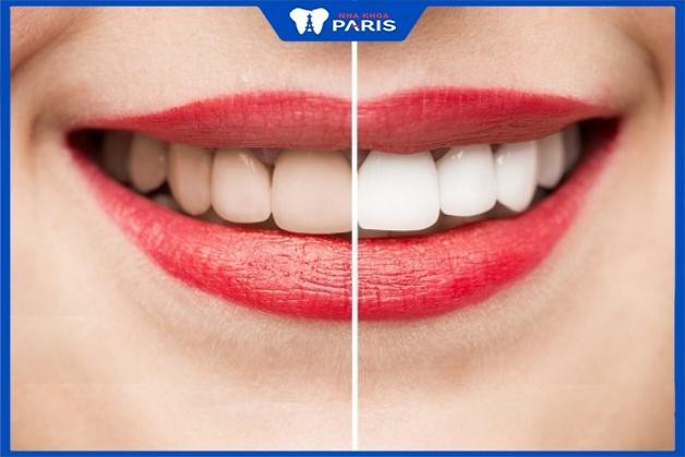 Công nghệ laser giúp răng trắng sáng ngay sau lần đầu thực hiện