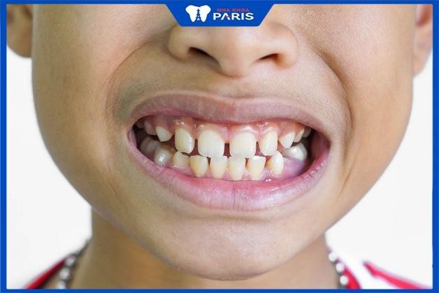 Hàm răng xấu ảnh hưởng đến cuộc sống trong tương lai