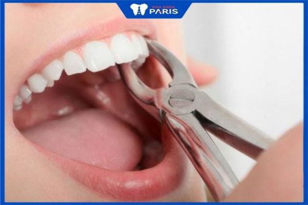 Nhổ răng có ảnh hưởng gì không – 3 trường hợp cần nhổ răng