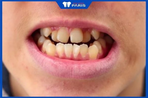 Niềng răng khểnh có phải nhổ răng không – Vị trí răng cần nhổ