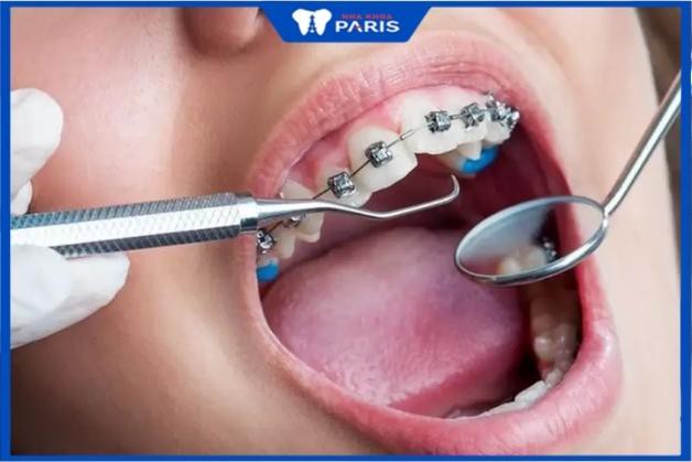 Niềng răng móm có phải nhổ răng không? Nha Khoa Paris
