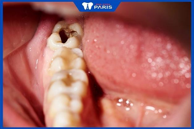 Răng bị sâu viêm tủy