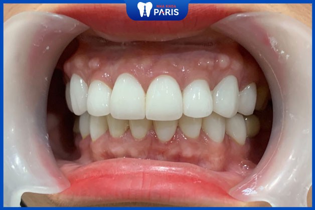 Tẩy trắng răng không gây mòn men răng nếu thực hiện đúng cách