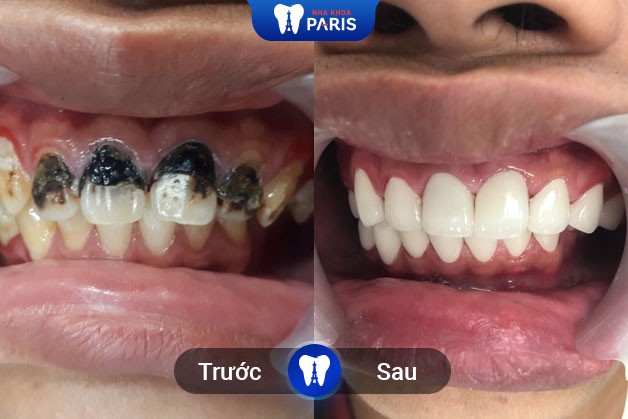 Khách hàng tẩy trắng răng tại Nha Khoa Paris