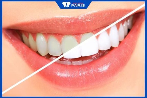 Tẩy trắng răng có nguy hiểm không – 2 lưu ý khi tẩy trắng răng