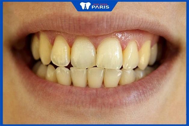 Người có răng ố vàng nên tẩy trắng răng Tẩy trắng răng có tốt không