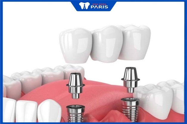 Cầu răng sứ có Implant hỗ trợ