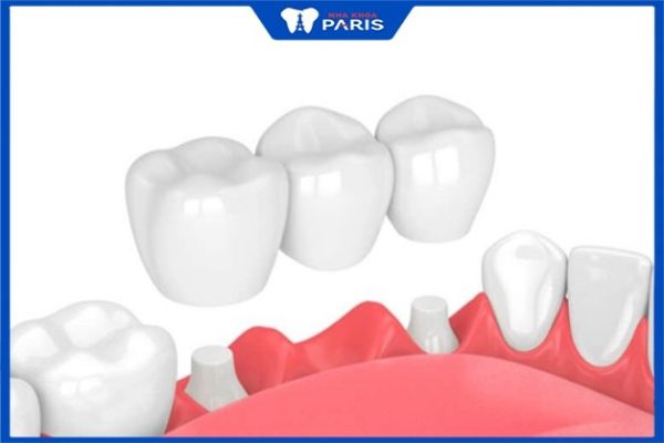 Trồng răng bắc cầu: Giải pháp thay thế răng thật an toàn