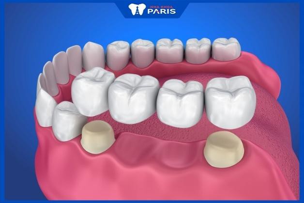 Trồng răng hàm có đau không khi bắc cầu răng sứ?