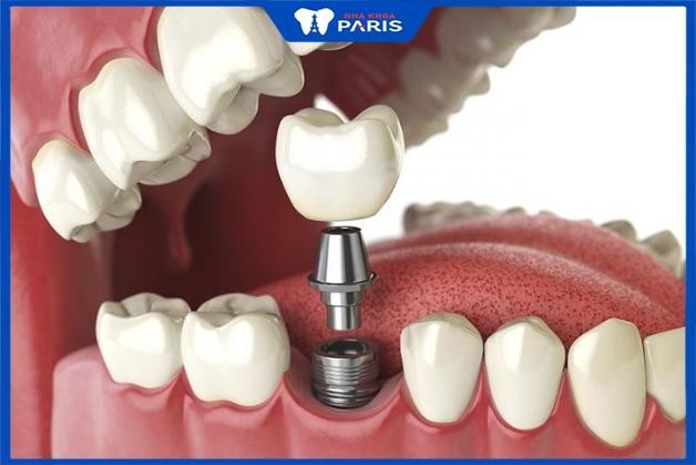 Trồng răng hàm có đau không nếu trồng Implant?