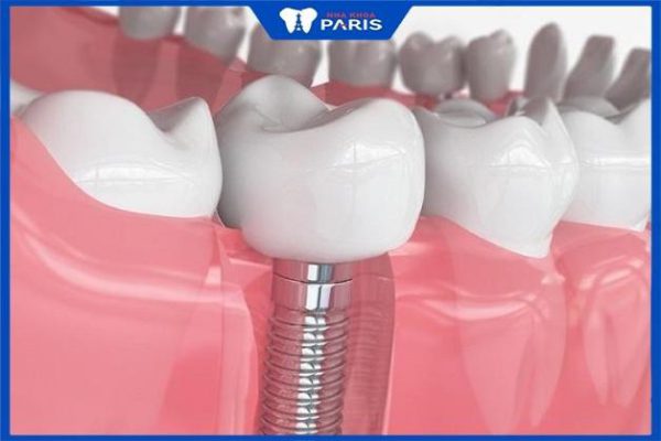 Trồng răng hàm mất bao nhiêu thời gian – Các yếu tố ảnh hưởng