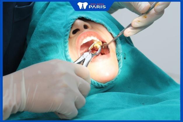 Bác sĩ nhổ răng khôn giỏi ở quận Tân Bình có nhiều ca nhổ răng thành công