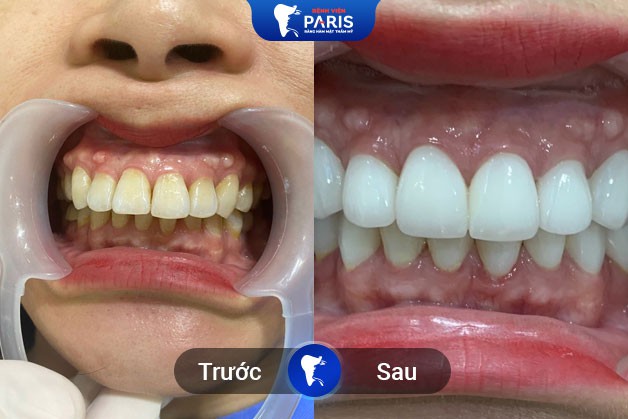 Tình trạng răng ố vàng được khắc phục sau khi tẩy trắng