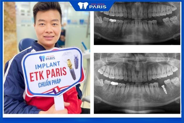 Khách hàng cấy ghép Implant tại Nha Khoa Paris
