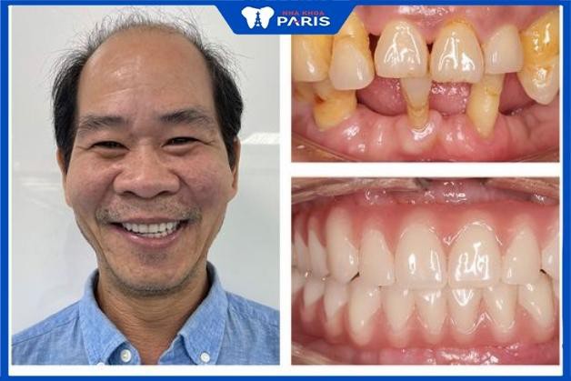 Khách hàng phục hình răng tại Nha Khoa Paris