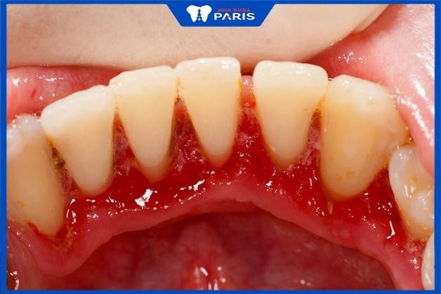 Bao lâu lấy cao răng 1 lần - Cao răng tăng nguy cơ mắc phải các bệnh lý răng miệng
