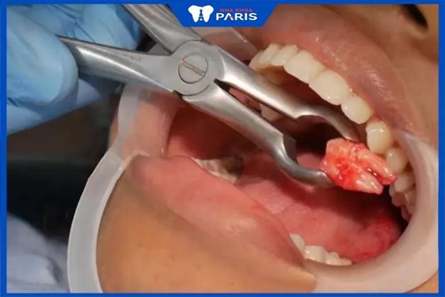 Khách hàng nhổ răng khôn tại Nha Khoa Paris