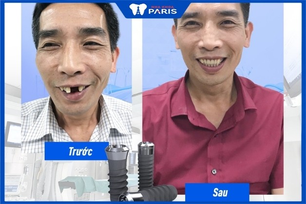 Khách hàng trồng răng Implant thành công