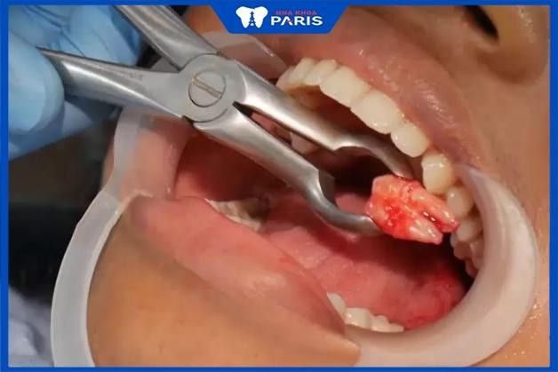 Hình ảnh khách hàng sau khi nhổ răng khôn tại Nha khoa Paris