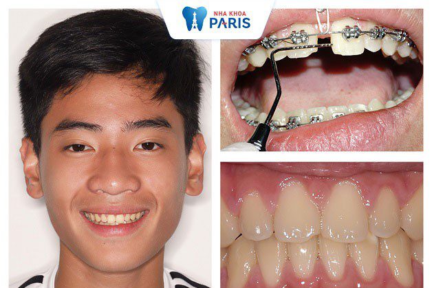 Kết quả khách hàng sau khi niềng răng tại Nha khoa Paris