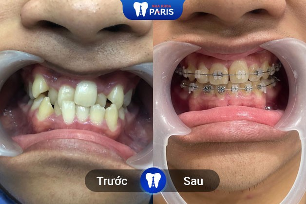 Kết quả niềng răng của khách hàng Nha Khoa Paris tại Quận 3