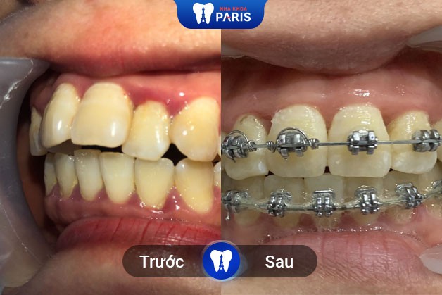 Kết quả niềng răng của khách hàng Nha Khoa Paris tại Quận 3