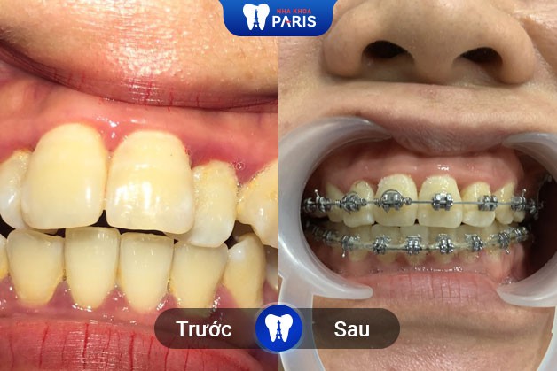 Kết quả niềng răng của khách hàng tại Nha khoa Paris Quận 3
