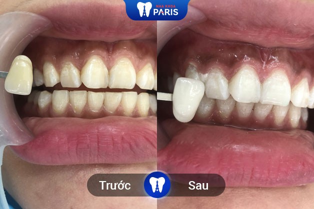 Kết quả trước và sau khi tẩy trắng tại Nha khoa Paris Quận 1