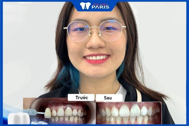 Khách hàng trước và sau khi dán răng sứ Nha Khoa Paris tại Đà Nẵng